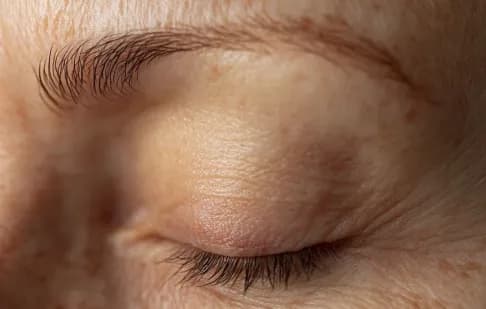 Lidstraffung (Blepharoplastik)